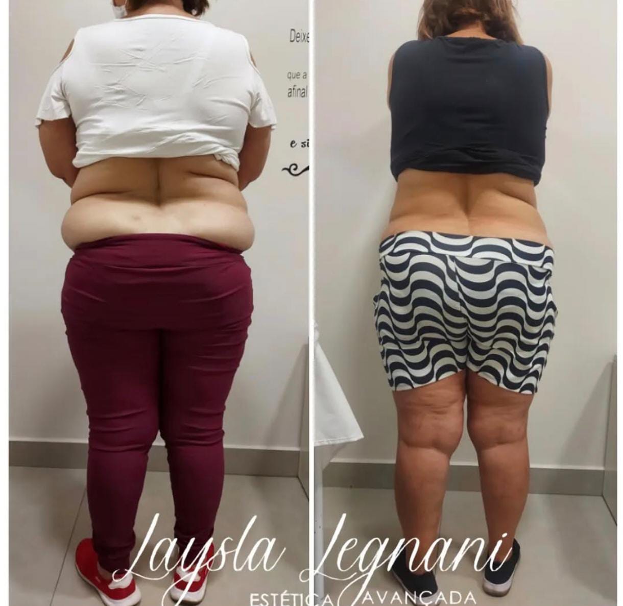 Antes e Depois - Emagrecimento