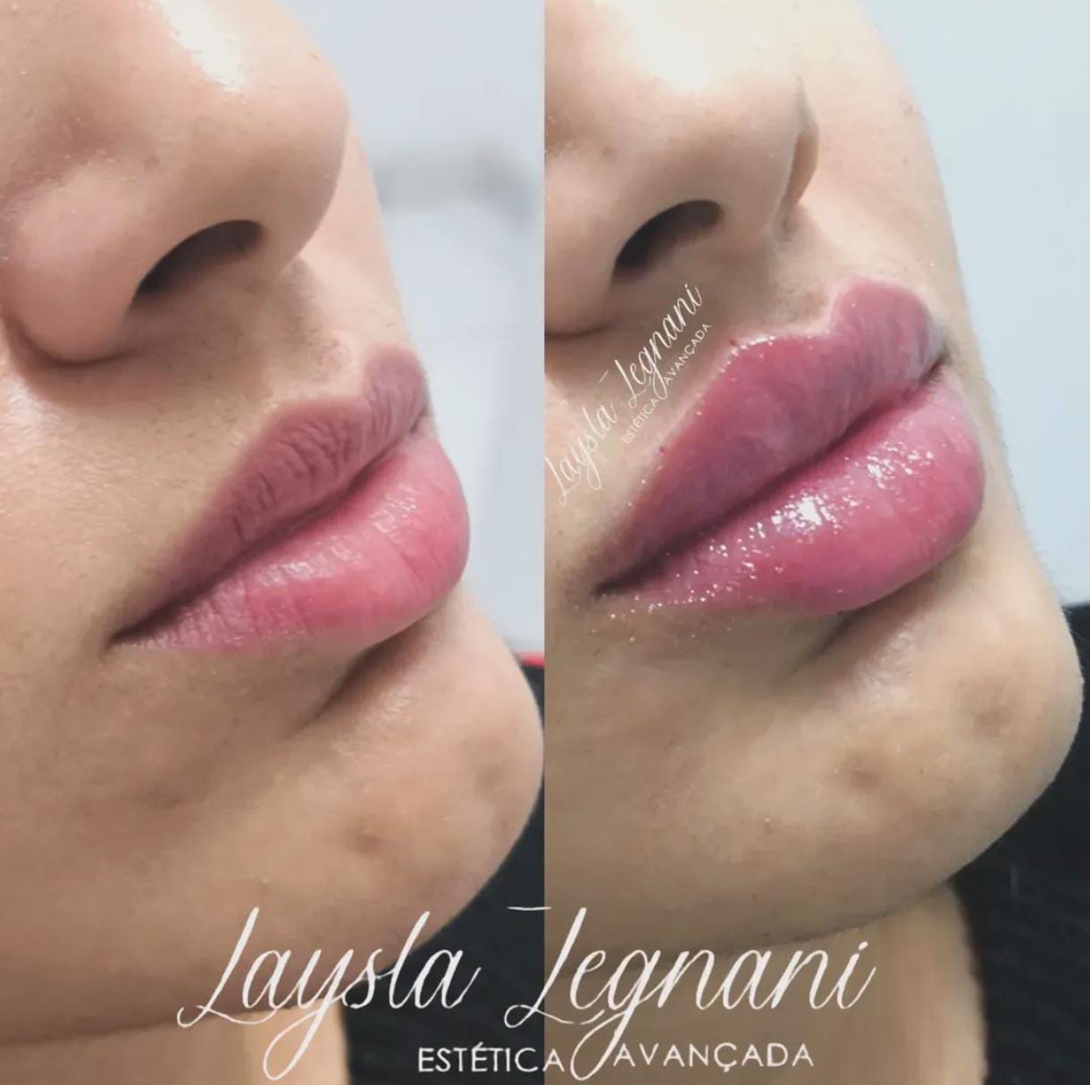 Antes e Depois - Preenchimento Labial