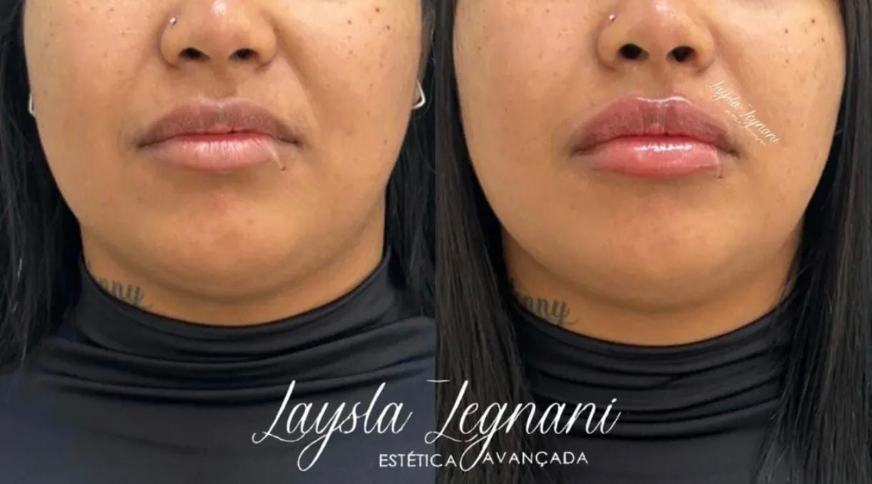 Antes e Depois - Harmonização Facial