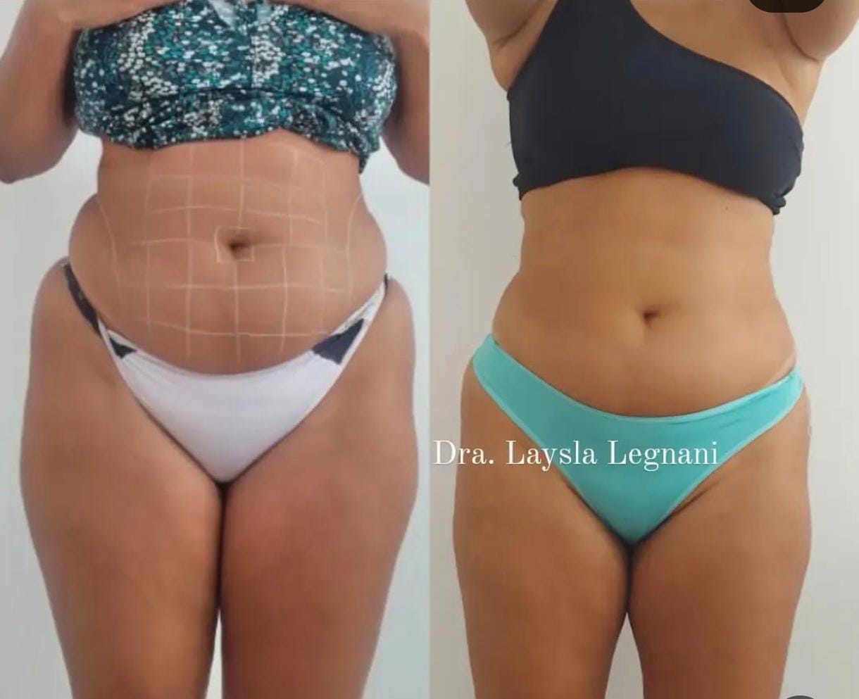 Antes e Depois - Redução Abdominal