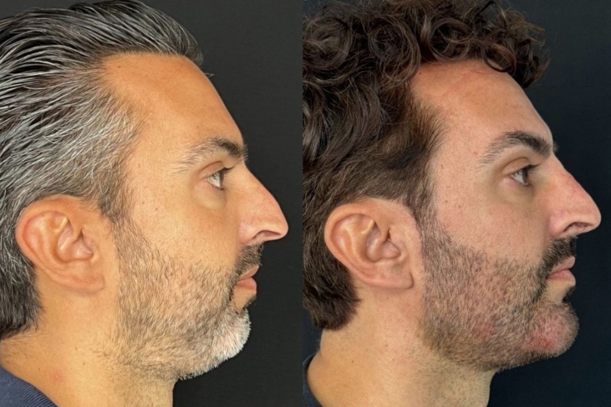 Preenchimento Mandíbula