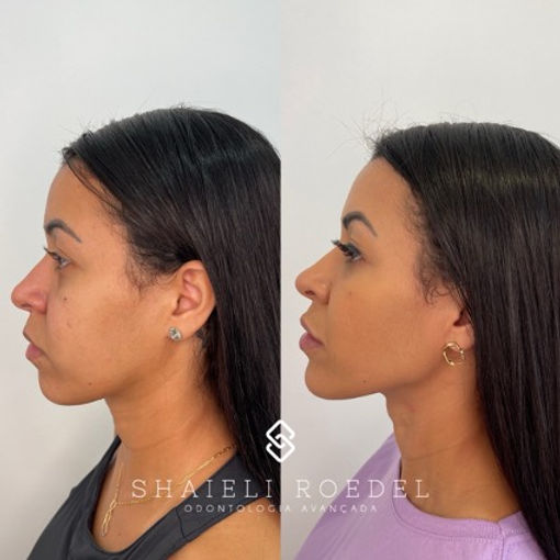 Preenchimento Queixo