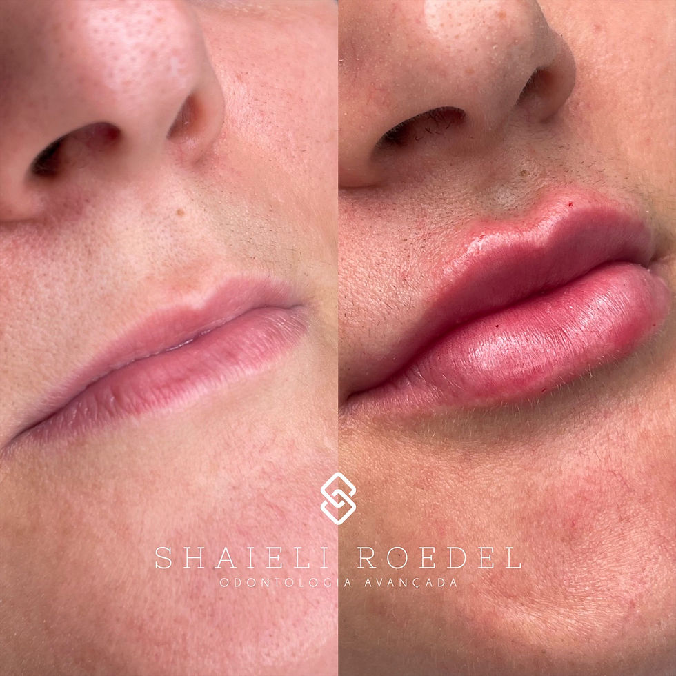 Preenchimento Labial