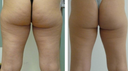 Eliminação de Celulites